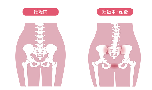 妊娠 後期 股関節 の 痛み